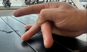 Bẻ ngón tay thư giãn có gây trật khớp? Bẻ ngón tay thư giãn có gây trật khớp?